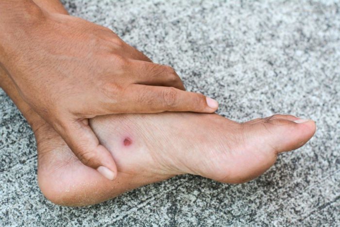 complicazioni delle ulcere del piede diabetico