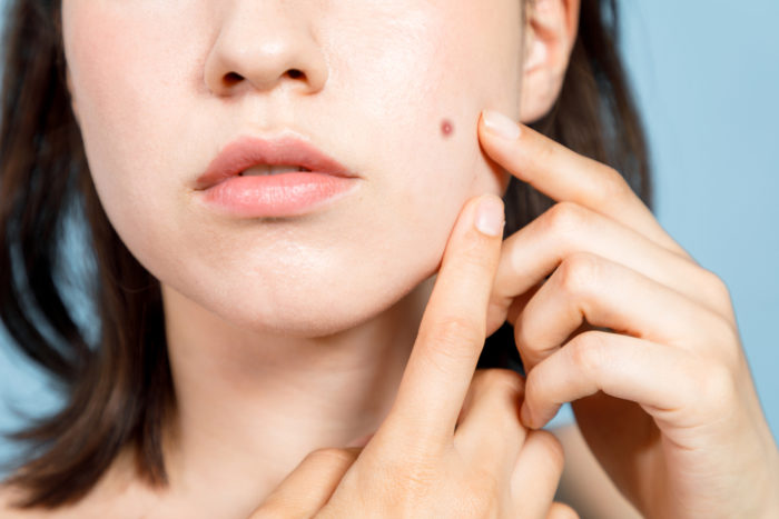 acne sulla pelle secca