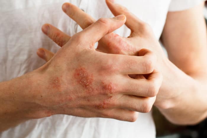 superare l'eczema nella mano