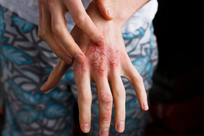 eczema secco e eczema umido