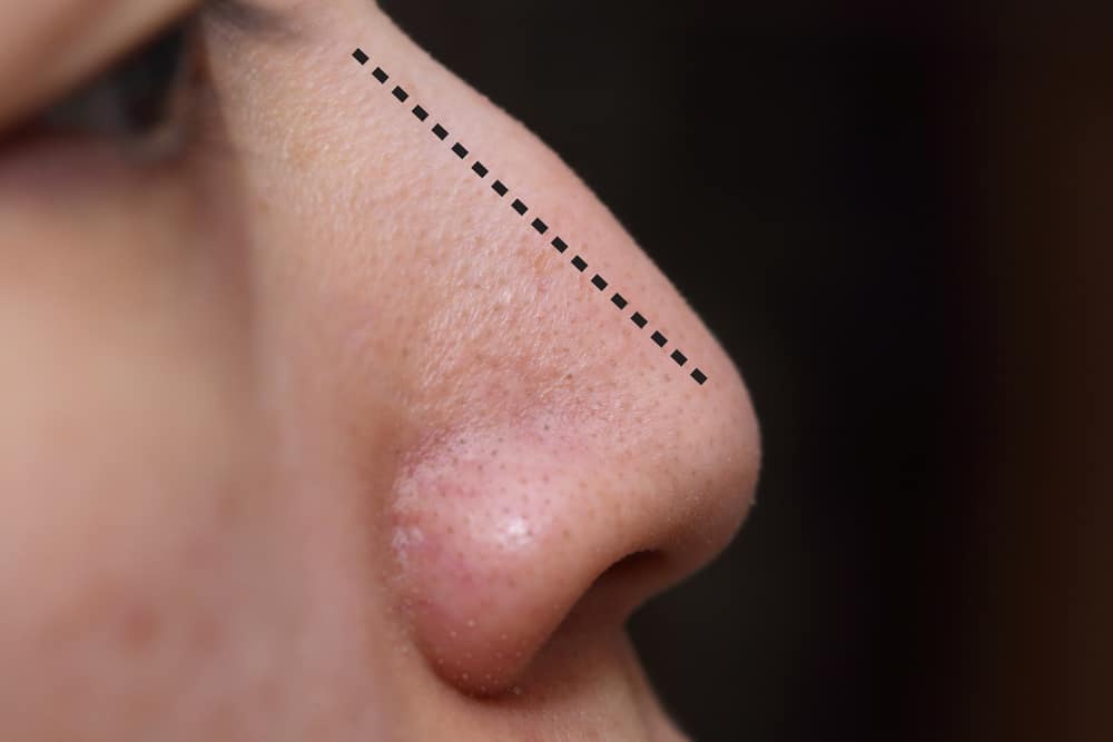 chirurgia del piercing al naso