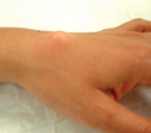 Cisti del ganglio al polso superiore (fonte: American Society for Surgery of the Hand)