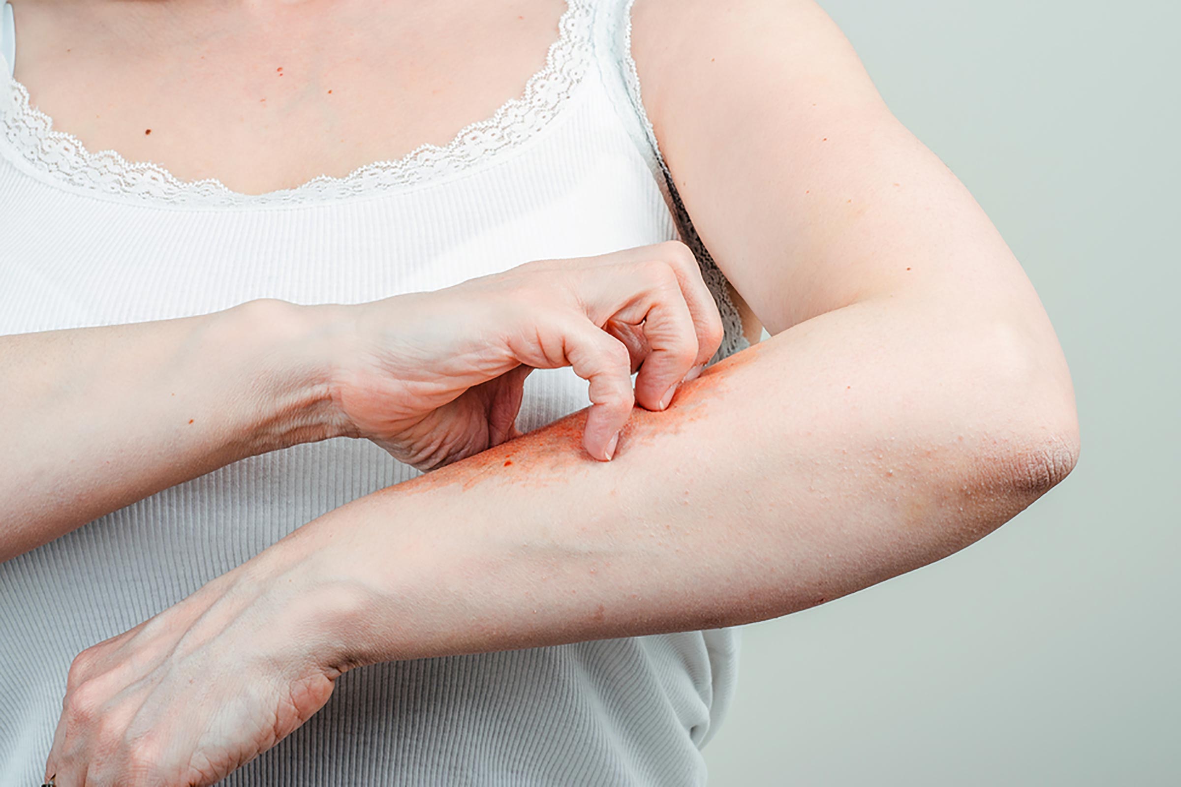 trattare l'eczema cutaneo