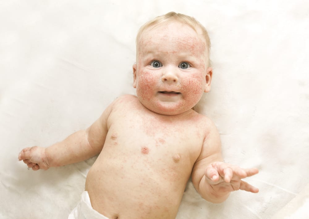 eczema nei neonati