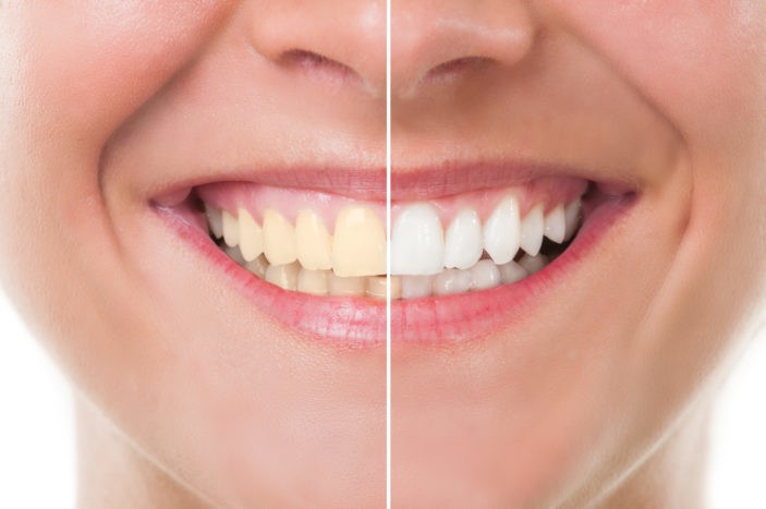 Effetti collaterali dello sbiancamento dei denti con lo sbiancamento
