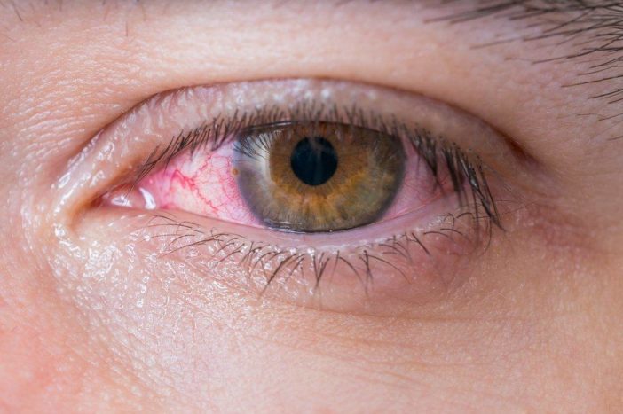 congiuntivite allergica agli occhi rossi
