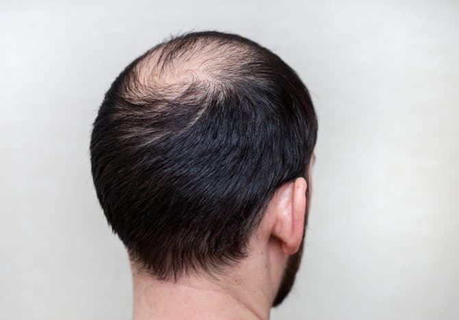trattare la perdita di capelli