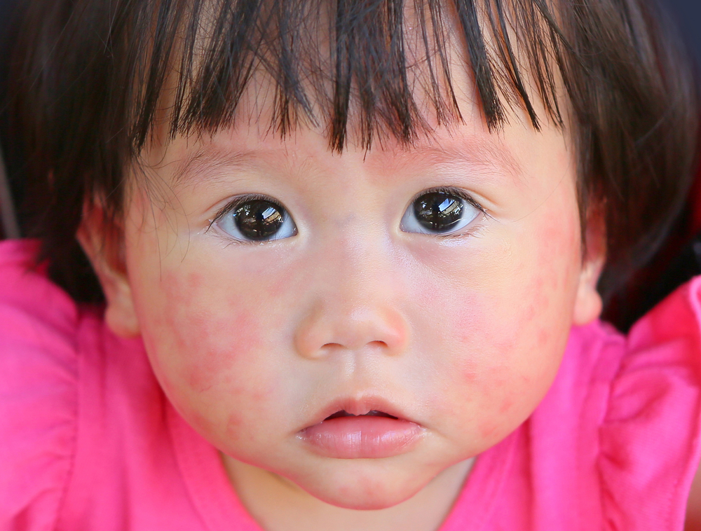 caratteristiche dei bambini allergici al latte vaccino