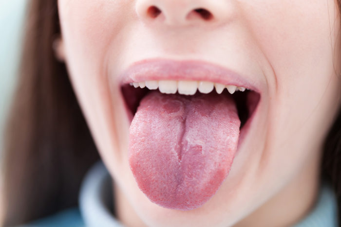 psoriasi della lingua