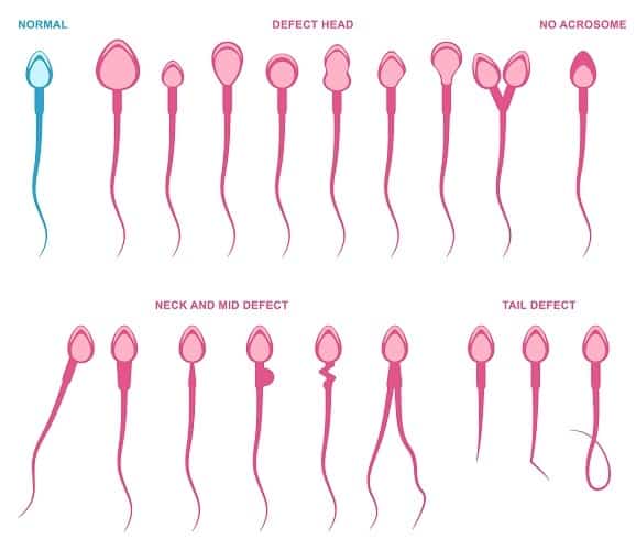 anomalie dello sperma