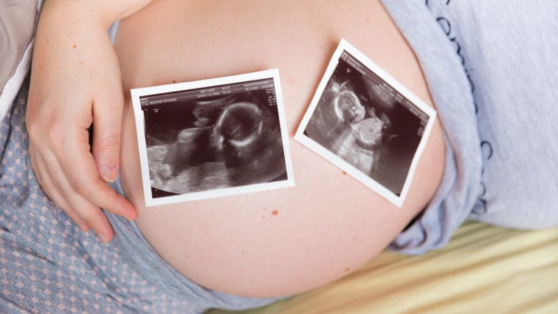 il rischio di rimanere incinta di due gemelli scompare
